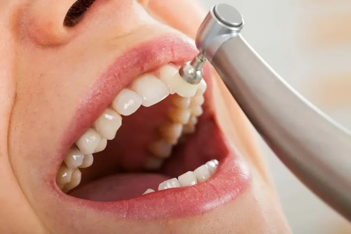 A tooth being polished during a dental cleaning