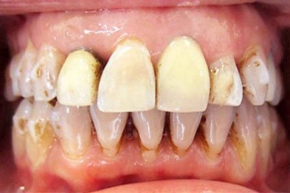 Smile before veneers