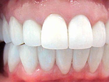 Smile following veneers